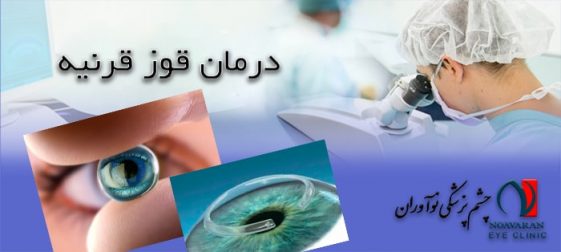 درمان قوزقرنیه