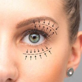 عمل بلفاروپلاستی